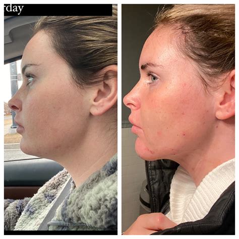 Chin lipo 18 hours later (tumescent and laser) super happy so far and ...