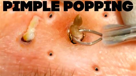 Best Pimple Popping Videos of 2021 - YouTube