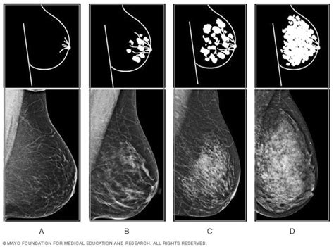 Dense breast tissue: What it means to have dense breasts - Mayo Clinic