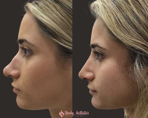 Liquid Rhinoplasty In NYC With D.Schwarzburg, MD