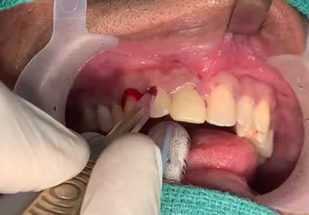 Tooth Cyst: Causes, Types, Symptoms and Treatment - Oral Health