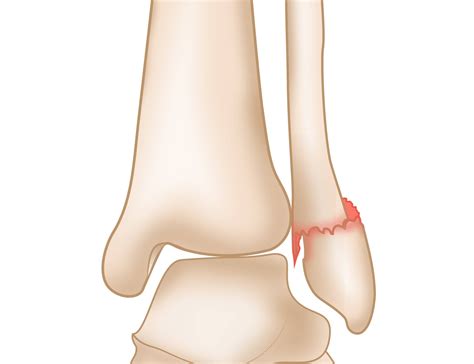 Lateral Malleolus Fracture