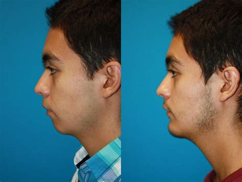 Chin Augmentation in Charleston, SC | Chin Surgery | Near Me