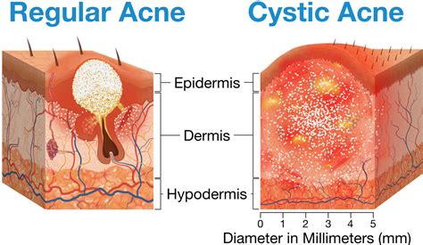 Cyst vs Pimple: Understanding the Differences and Treatment Options ...