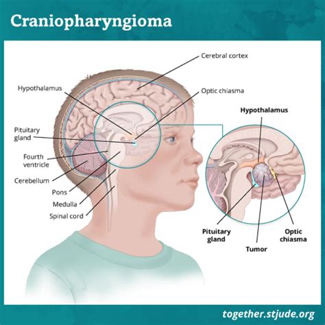 Craniopharyngioma in Children and Teens - Together