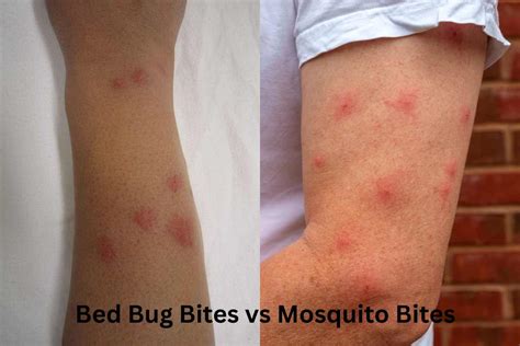 How to Tell Mosquito Bites from Bed Bugs?