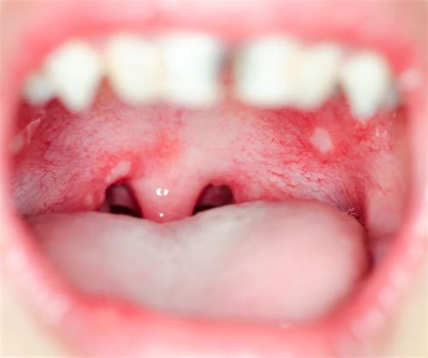 Everything You Need to Know About Mouth Ulcers - Grange Family Dental