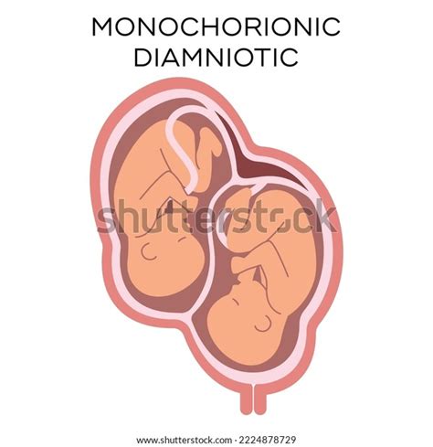 Monochorionic Diamniotic Twins Vector Illustration Flat Stock Vector ...