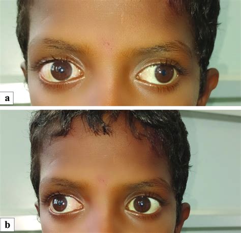 [Figure, Bilateral Exotropia. (a) Image of...] - StatPearls - NCBI ...