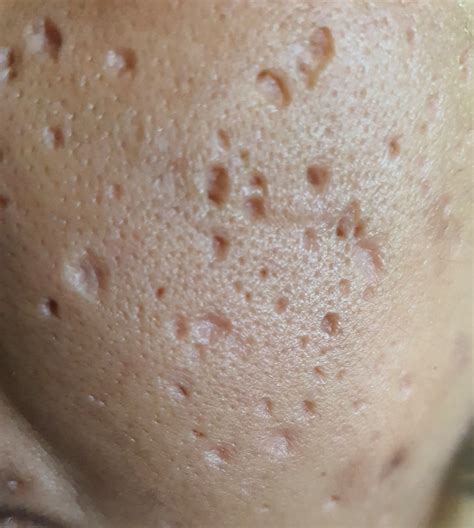 Cystic Acne Scars