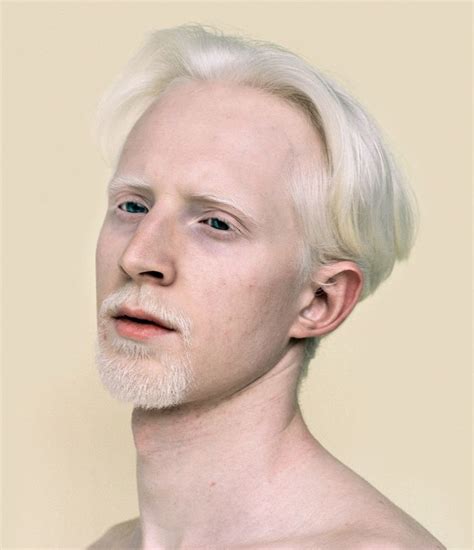 Mini Title — Personal - ericnehr | Albino human, Albino men, Albino