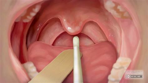 Oropharyngeal Swab Procedure