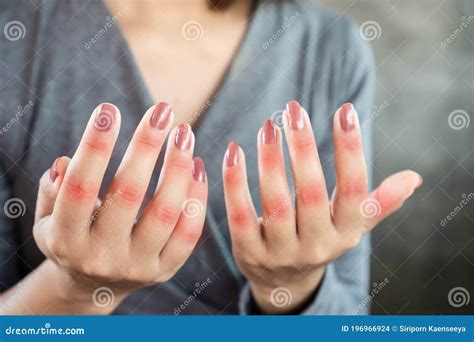 Woman Hand Suffering from Joint Pain with Gout in Finger Stock Photo ...