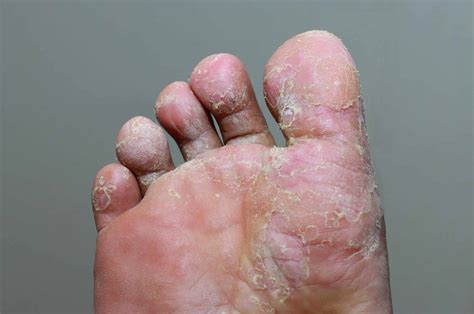 The Types of Fungal Foot Infections - A Podiatrist's Guide