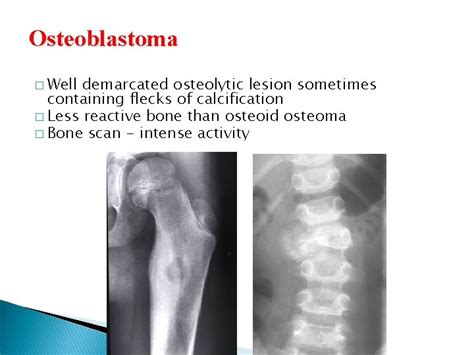 Radiology of Bone Tumors Xrays the question need