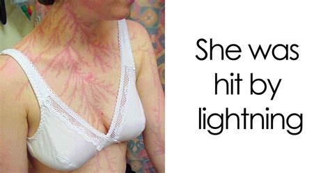 Lichtenberg Scars — Nature’s Tattoo You Don’t Want To Have | Bored Panda