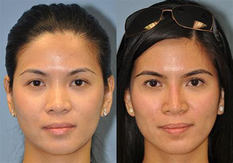 Liquid/Non-Surgical Rhinoplasty in Virginia and Maryland