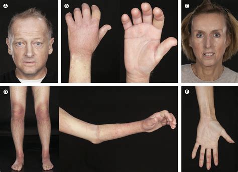 Systemic sclerosis - The Lancet