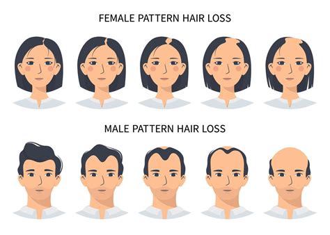 Hair loss stages, androgenetic alopecia male and female pattern. Steps ...