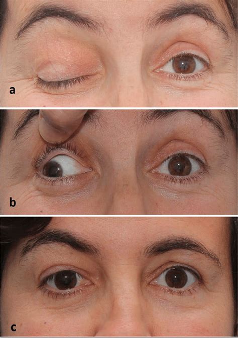 Photographs taken before surgery show (a) complete ptosis with absence ...