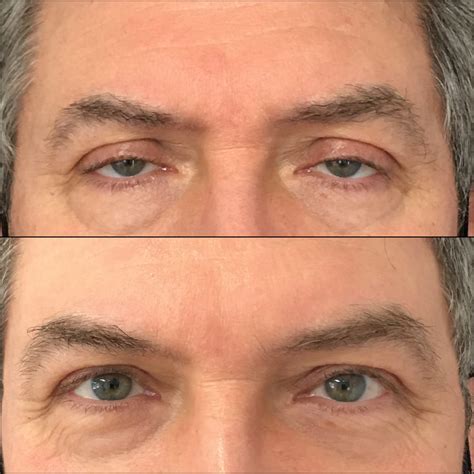 Ptosis Repair Before & After Photos | Flora Levin MD