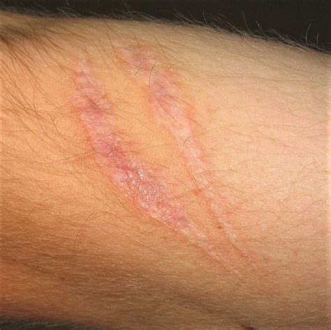 About Scars - Burn Survivor