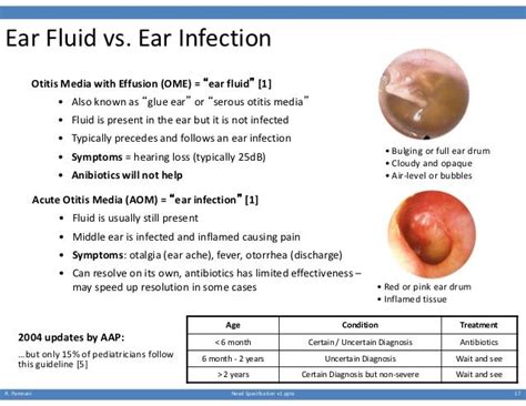 Ear Fluid vs. Ear Infection Otitis Media with Effusion (OME) = “ear ...