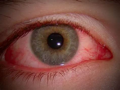 Eye Flu: Symptoms and Treatment