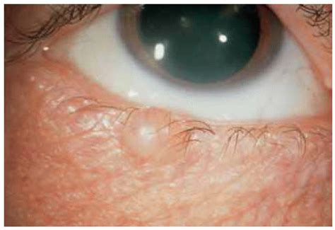 Sebaceous Cyst Eyelid