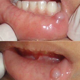 (PDF) ORAL MUCOCELE: A CASE REPORT