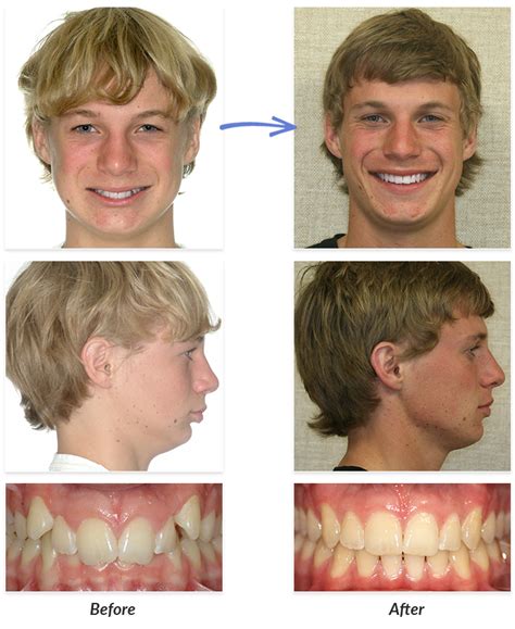 Before & After Braces Photos | DeLurgio Orthodontics : DeLurgio ...