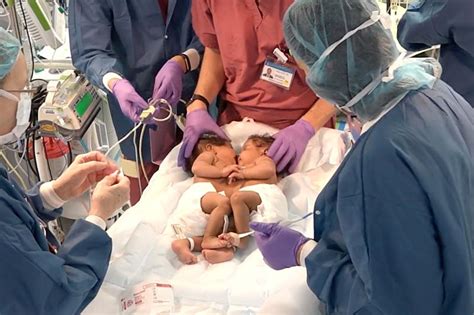 Inside the Successful Separation Surgery of Conjoined Twins | Columbia ...