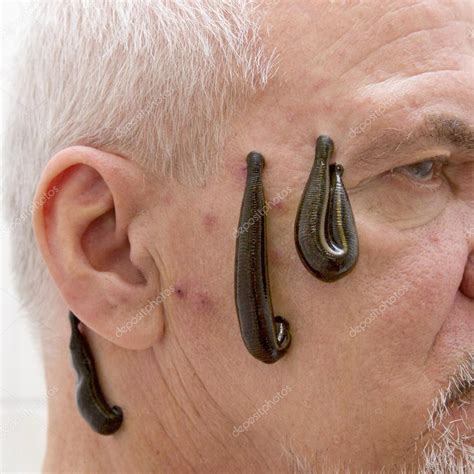 Leech therapy Stock Photo by ©sdigitall 58263991