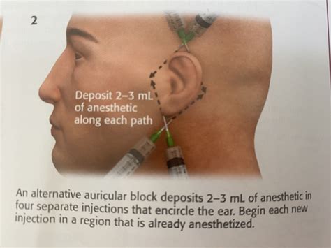 Auricular Blocks and Hematomas — The Proceduralist