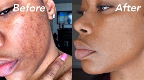 Hyperpigmentation Acne Scars Types - beckybeatle