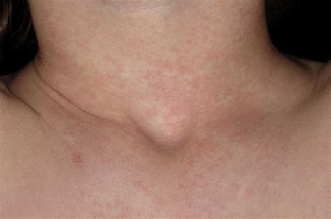 Scarlet Fever Rash Photograph by Dr P. Marazzi/science Photo Library