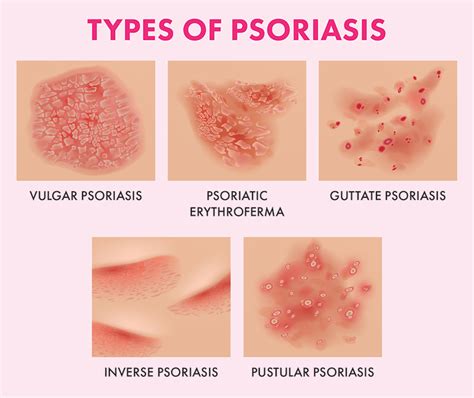 The Ultimate Guide To Psoriasis: What Causes It And How To Treat It ...