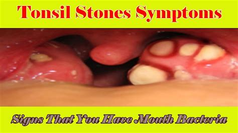 Tonsil Stones Symptoms: Signs That You Have Mouth Bacteria Infection ...