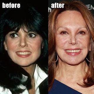 Marlo Thomas Plastic Surgery Before and After Facelift - Star Plastic ...