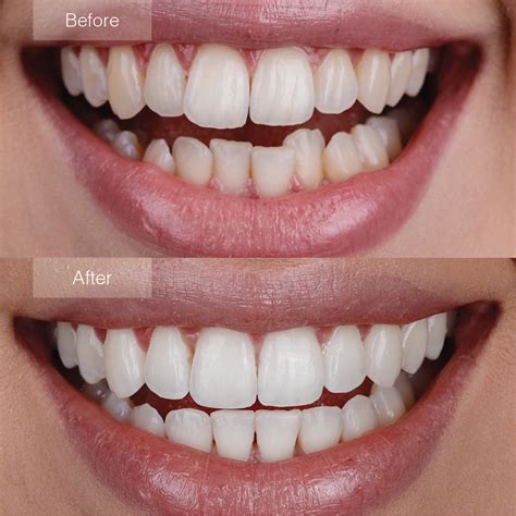 Invisalign Before and After - The Dental Room