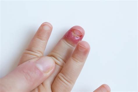 Infection Around Fingernail Cuticle - Awesome Nail