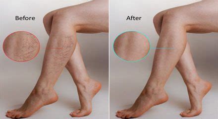 Varicose Veins Laser Treatment Recovery Time | Potent Medical