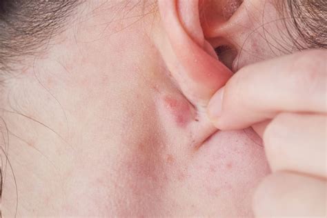 Lumps Behind the Ear: 6 Causes & When to See a Doctor - Tua Saúde