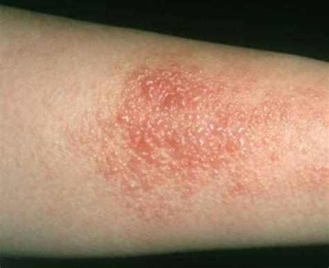 Mild Contact Dermatitis