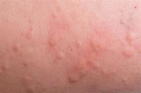 Allergic Purpura