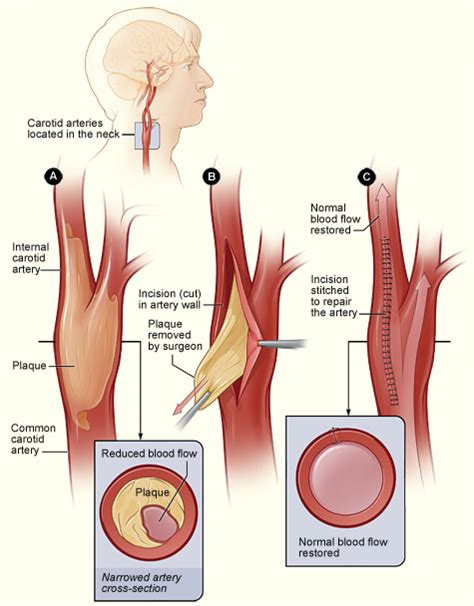 Vascular & Endovascular Surgery - Carotid Endarterectomy