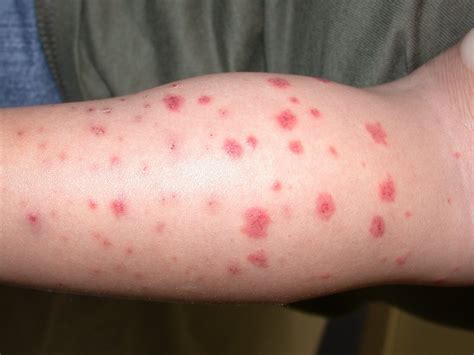 Mild Petechiae Legs