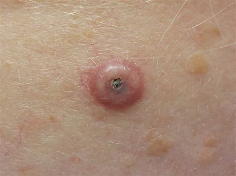 What Is Cutaneous Squamous Cell Carcinoma Symptoms Causes Diagnosis ...