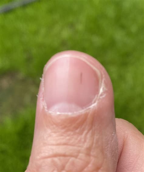 Black line on nail? Should I be worried? | Mumsnet