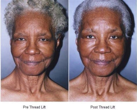 Thread Lift Before and After Photo Gallery | Dr. Kane